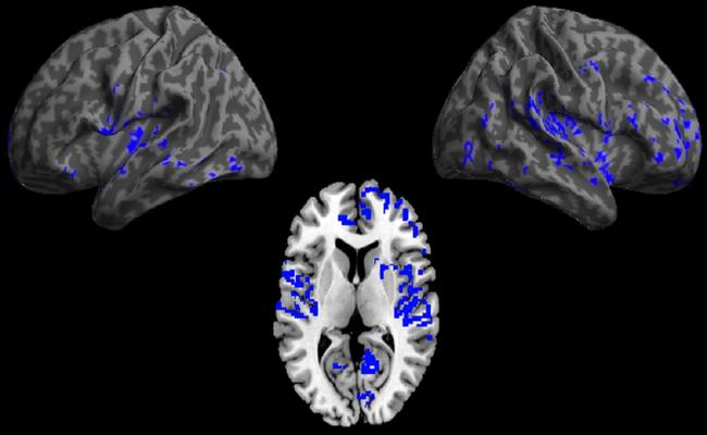 Language And Cognitive Impairment In Parkinson's Disease